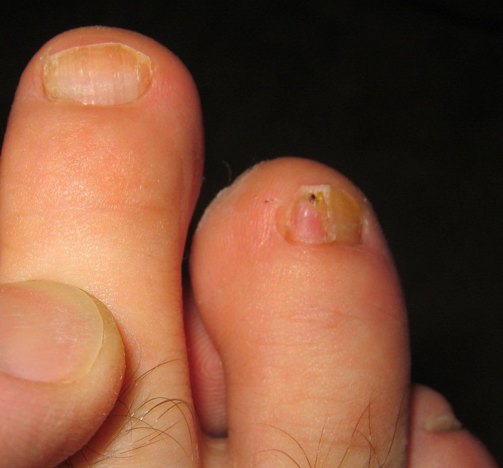 kezelést onychomicosis foot nail gomba)