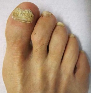 What Causes Thick Toenails in the Elderly? 