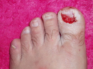 big toenail fungus