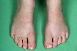 treating toenail fungus