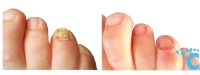 revolution-toenail-result-1a-branded