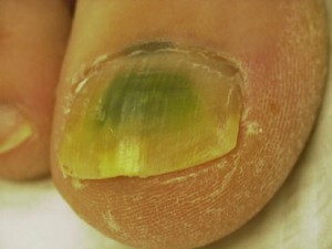 Nail Discoloration