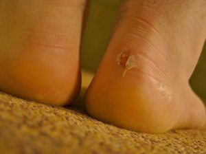 blister-care-for-runners-clear-toes-clinic