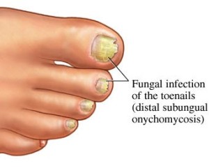 Fungal-Toenail