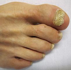 Oncymycosis, Toenail Fungus