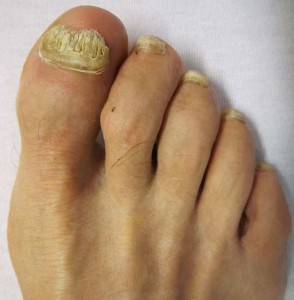 toenail fungus