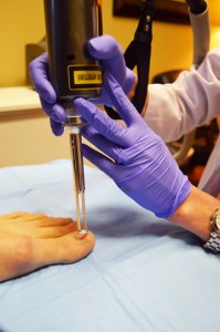 treating toenail fungus