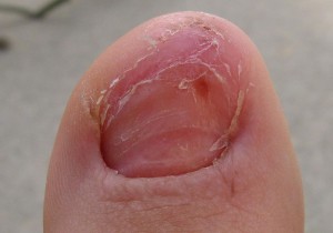fungus infected toenail