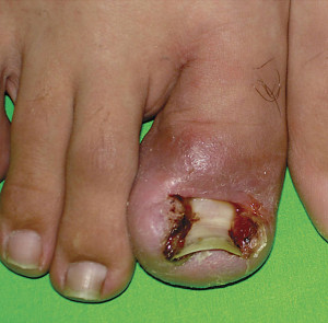 ingrown toenail