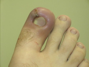 how to spot toenail fungus