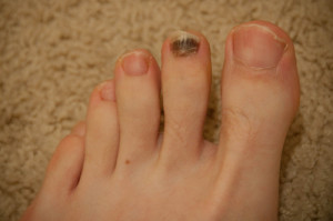 laser treatment for toenail fungus