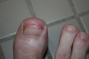 broken toenail
