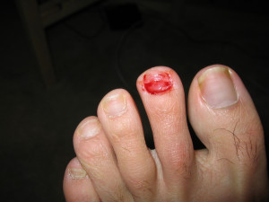 treat toenail fungus