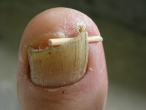 toenail fungus