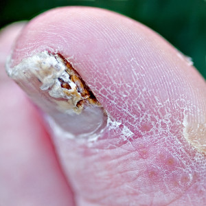 fungus on toenails