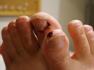 solutions to cure toenail fungus