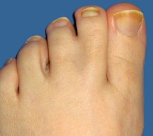 how to avoid toenail fungus