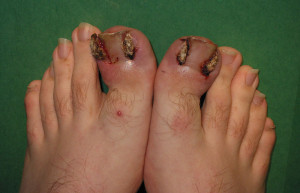 Toenail Fungus Side Effects