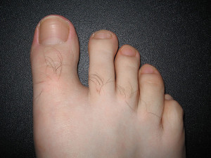 nail salons and toenail fungus