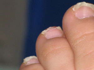 toenail fungus treatment