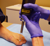 Laser Treatment