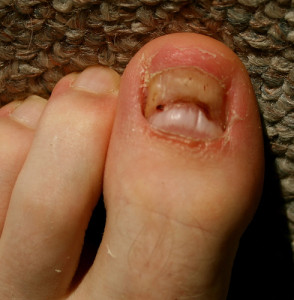 sweaty Feet Affect Toenail Fungus