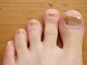 kill toenail fungus