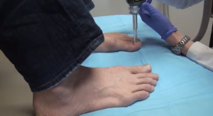 treating toenail fungus