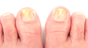 signs of toenail fungus