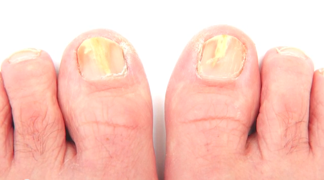 treating toenail fungus