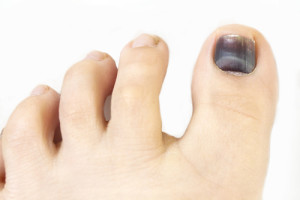 Black toenail fungus houston