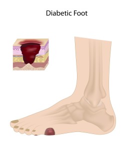 Foot fungus Houston diabetic