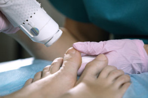 laser-treatment-for-toenail-fungus